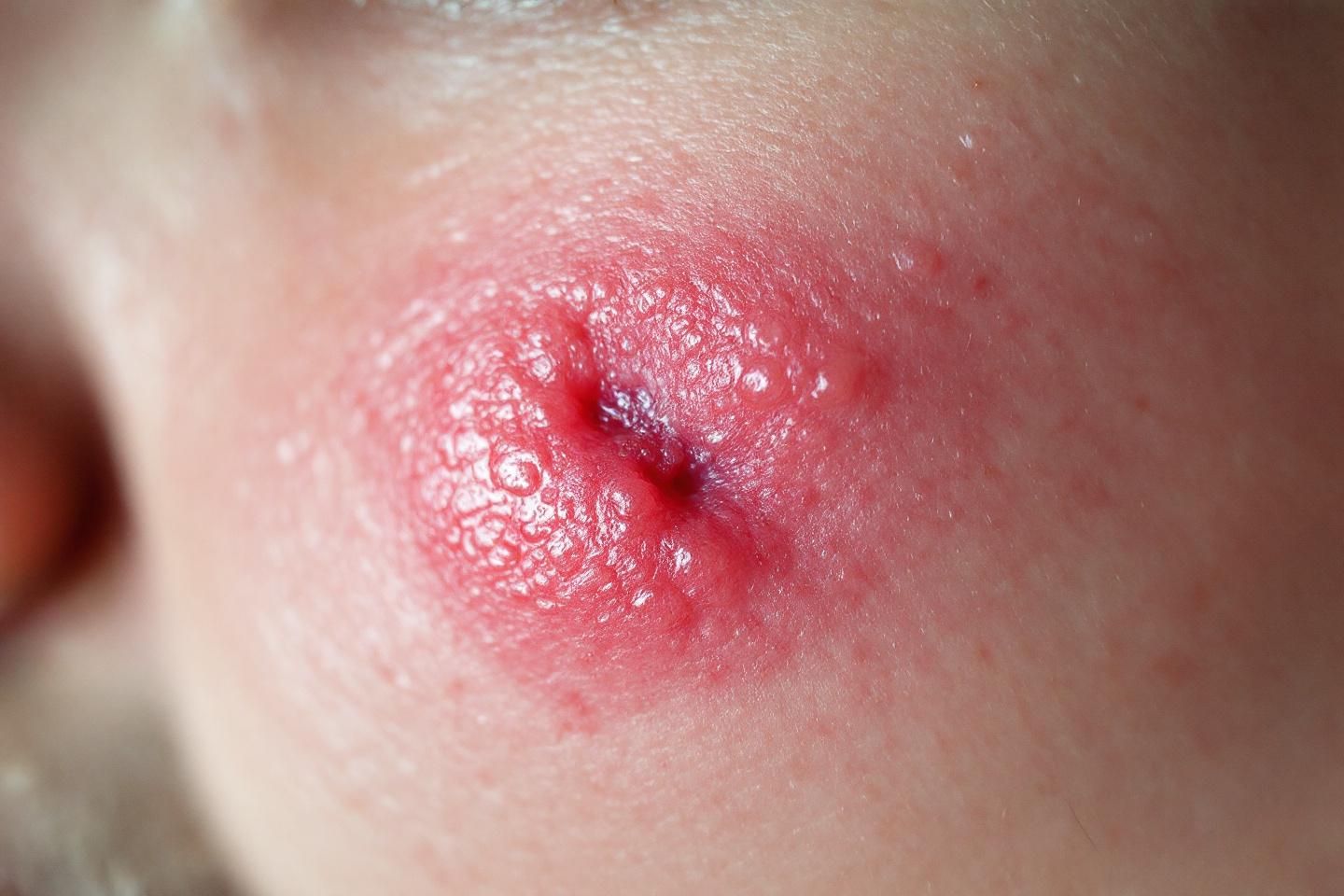 Synthèse : optimiser la santé de votre peau pour minimiser les boutons Synthèse : optimiser la santé de votre peau pour minimiser les boutons